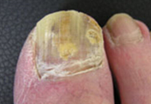FUNGAL NAILS | Common Foot Problem