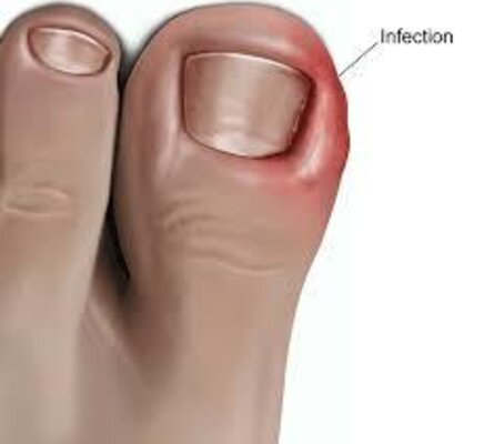 Duplicate Ingrown toenail treatment and surgery